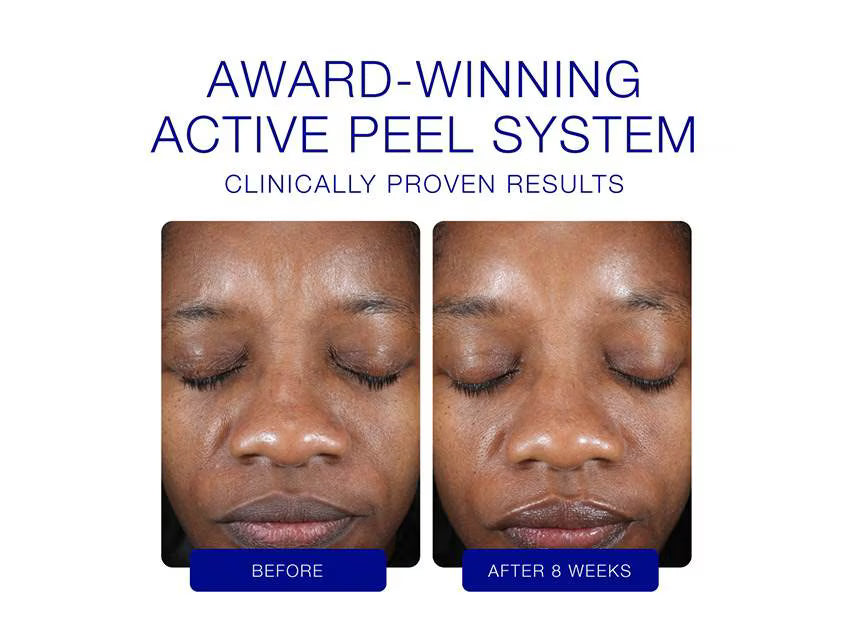 Active Peel System