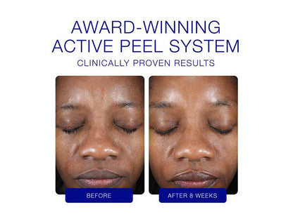 Active Peel System