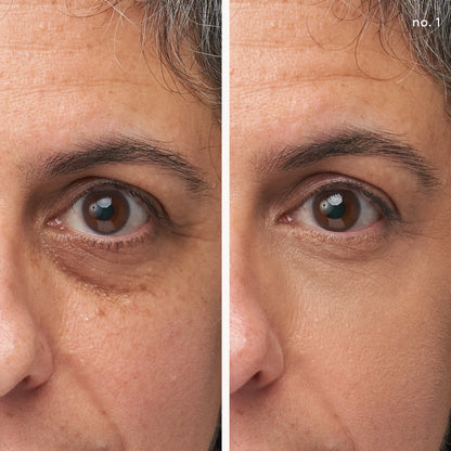 Before and after comparison of a person's eye area with visible skin texture differences.