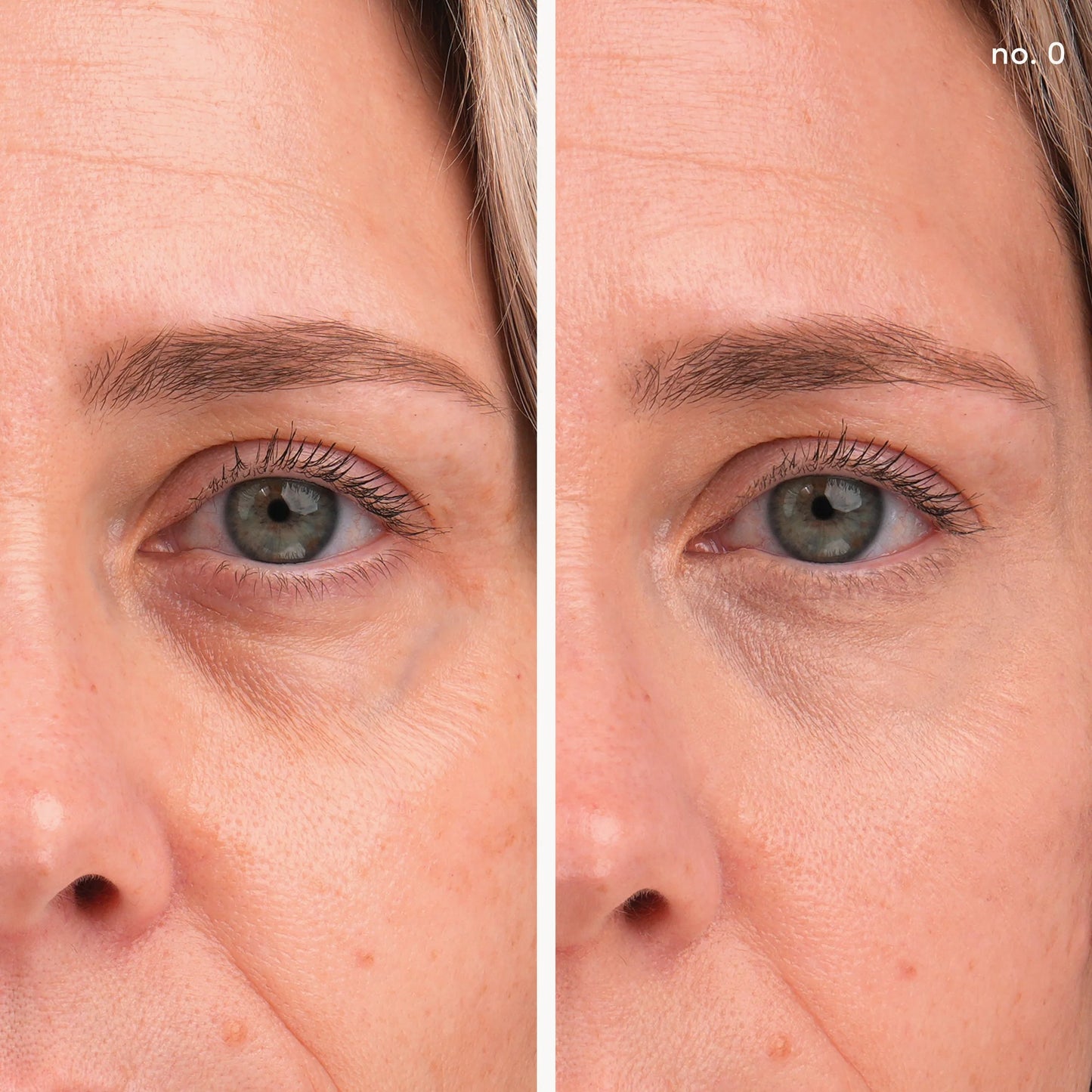 Before and after comparison of a woman's eye area with visible skin texture and lines.