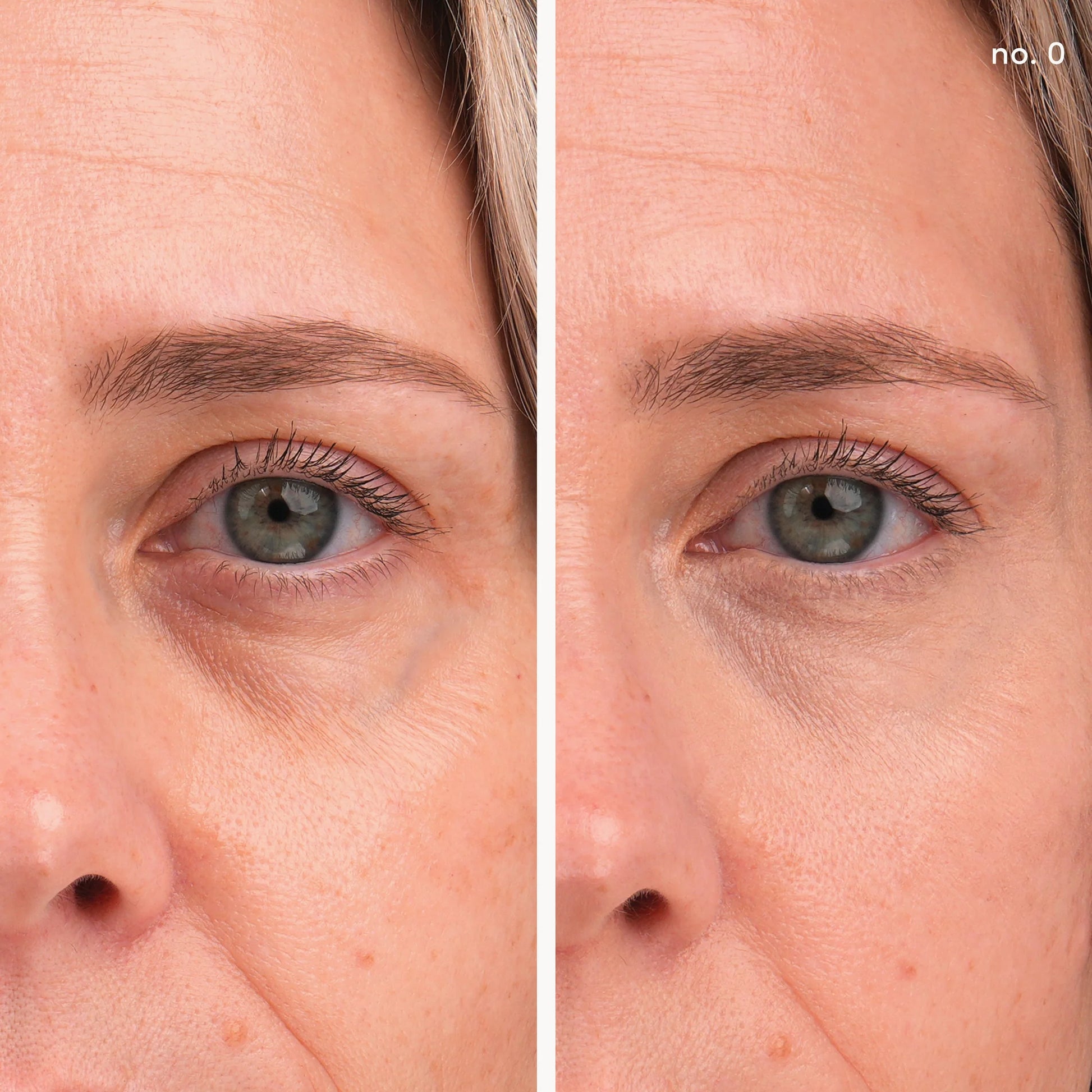 Before and after comparison of a woman's eye area with visible skin texture and lines.