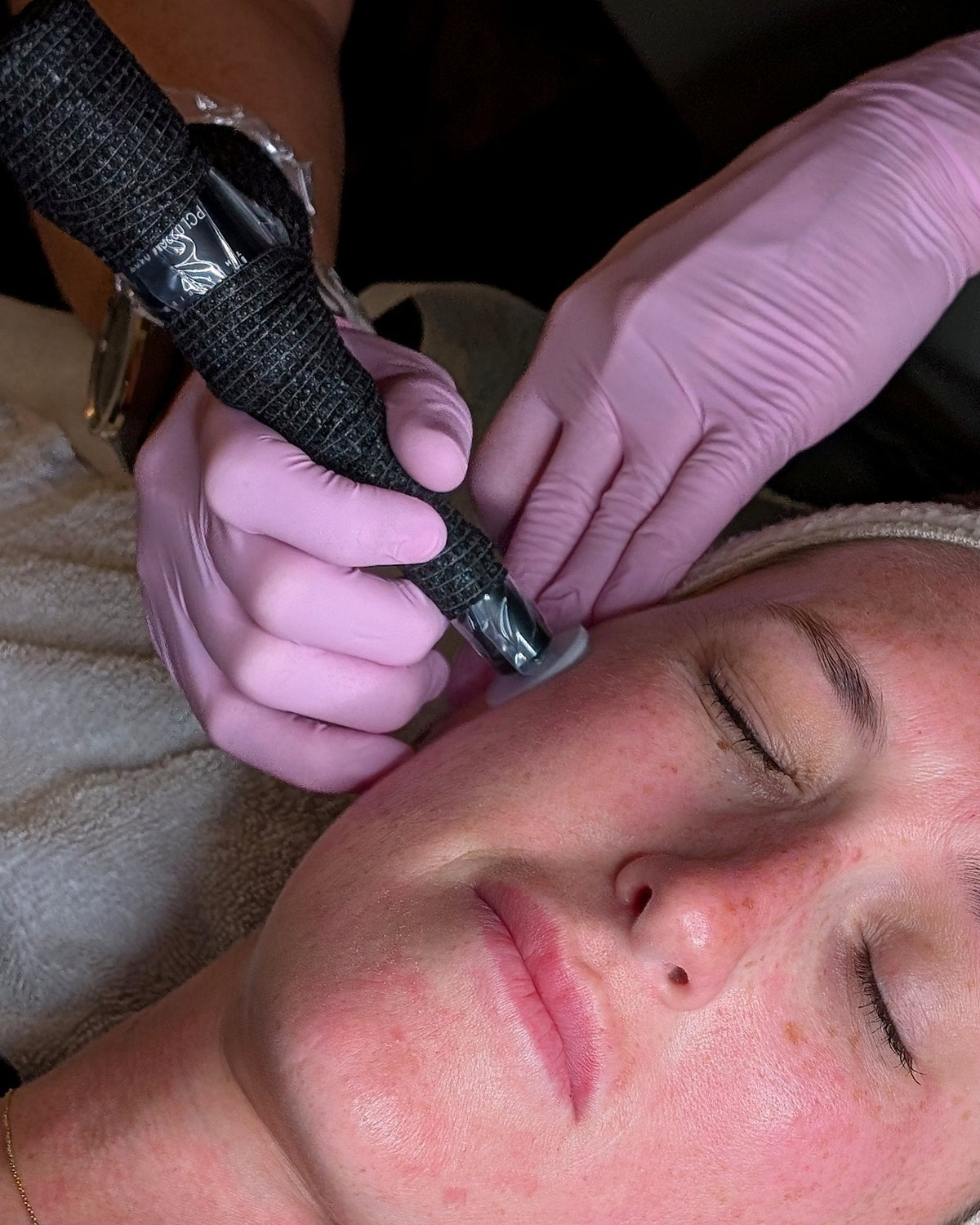 Close-up of the ProCell microchanneling device on a client's cheek during treatment